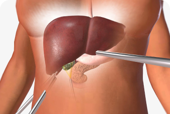 laparoscopic gallbladder removal