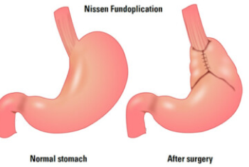 nissen surgery